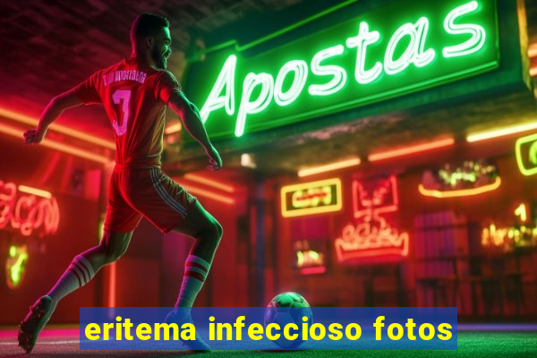 eritema infeccioso fotos